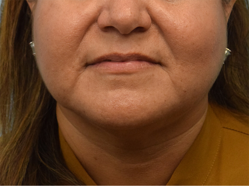 Buccal Fat Removal Before & After Image