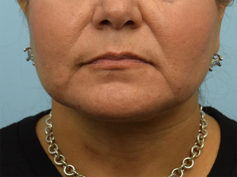 Buccal Fat Removal Before & After Image