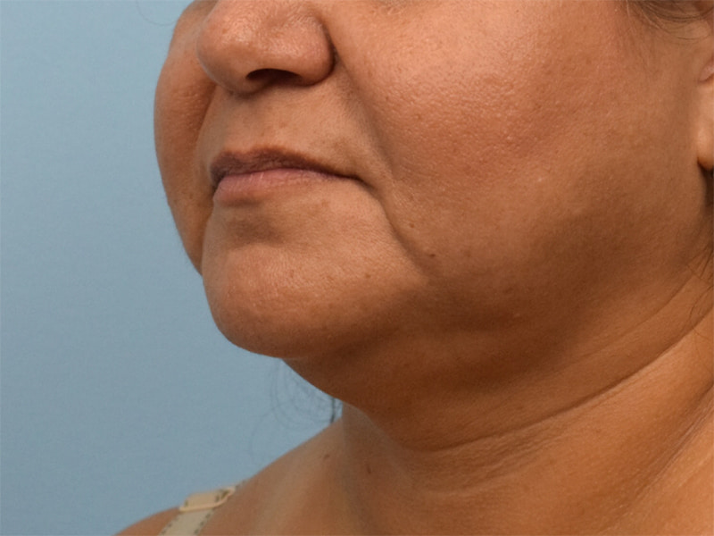 Buccal Fat Removal Before & After Image