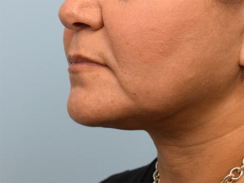 Buccal Fat Removal Before & After Image