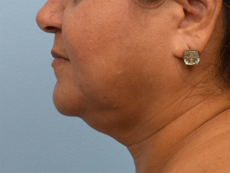 Buccal Fat Removal Before & After Image