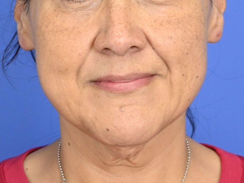 Buccal Fat Removal Before & After Image