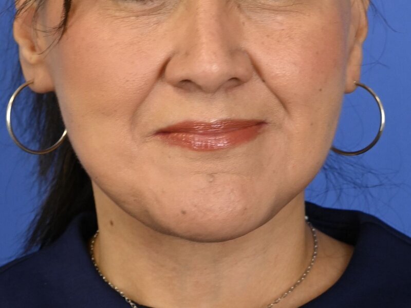 Buccal Fat Removal Before & After Image