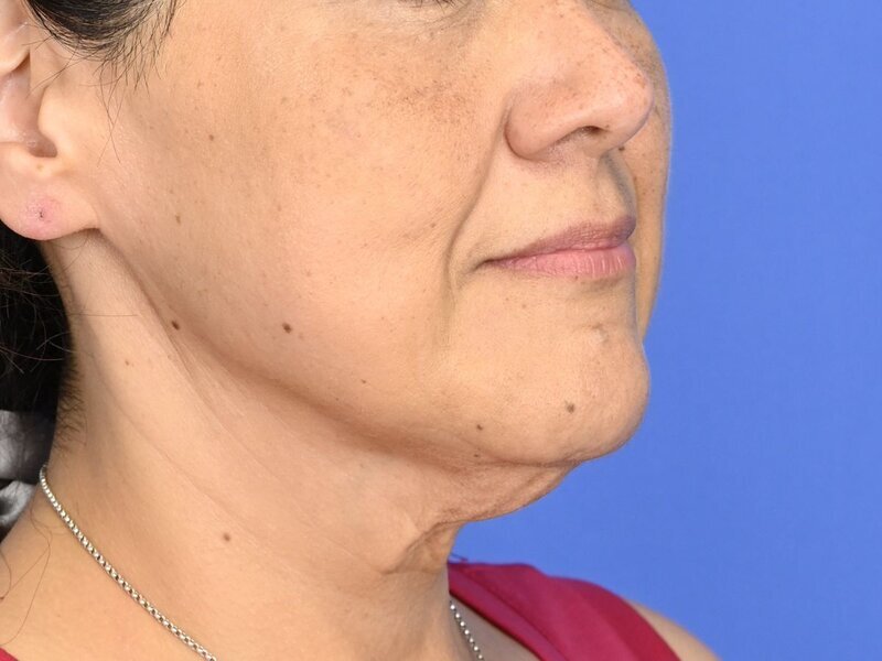 Buccal Fat Removal Before & After Image