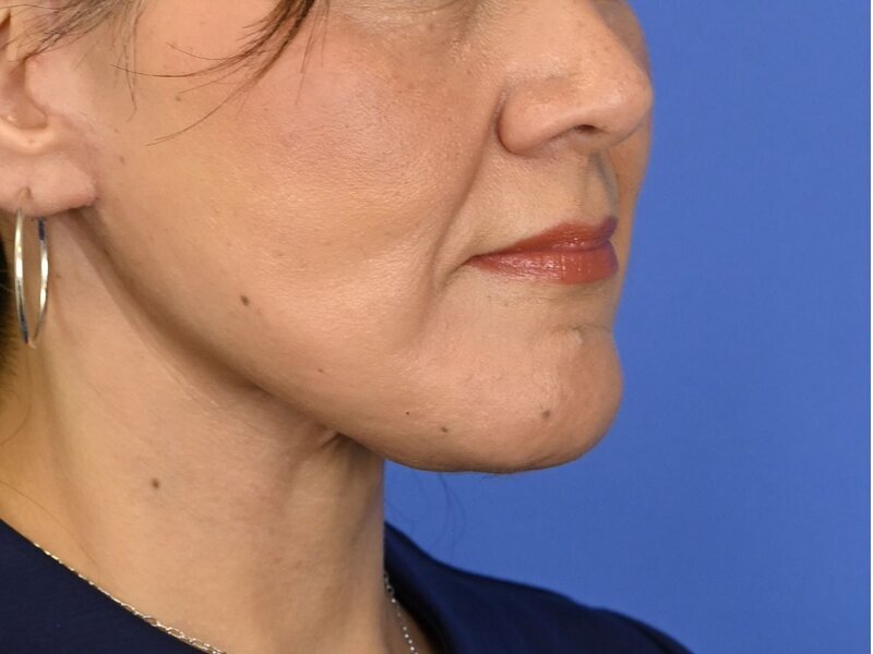 Buccal Fat Removal Before & After Image