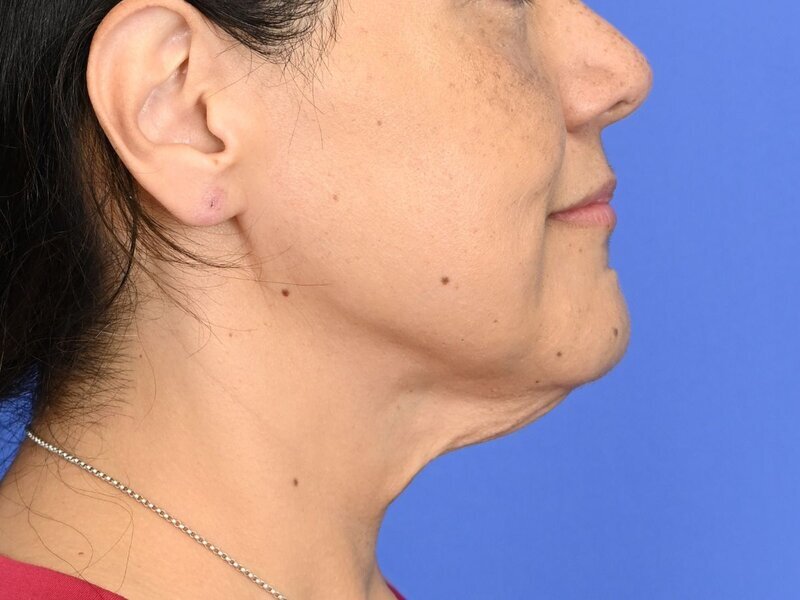 Buccal Fat Removal Before & After Image