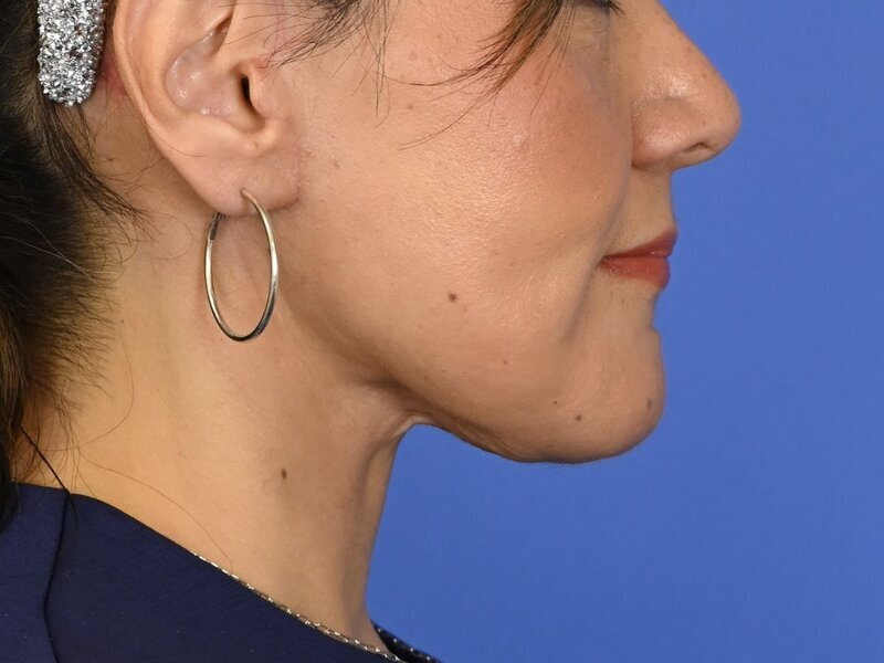 Buccal Fat Removal Before & After Image