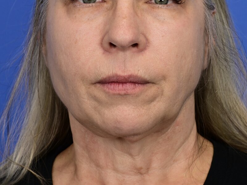 Buccal Fat Removal Before & After Image