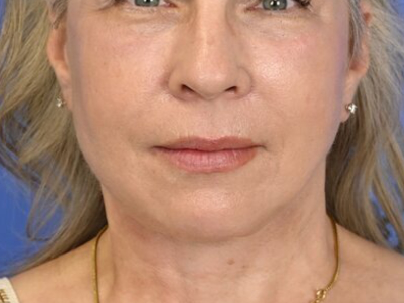 Buccal Fat Removal Before & After Image