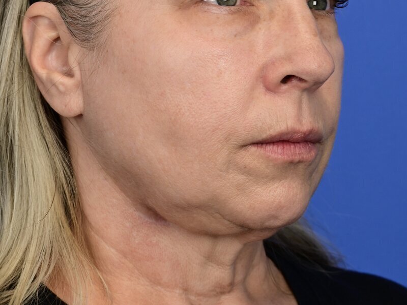 Buccal Fat Removal Before & After Image