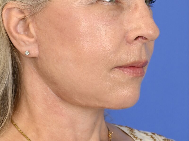 Buccal Fat Removal Before & After Image