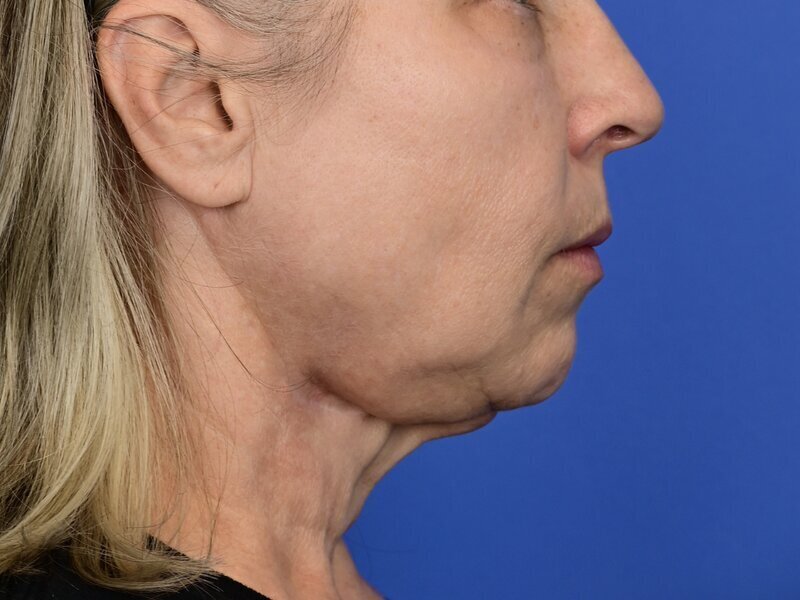 Buccal Fat Removal Before & After Image