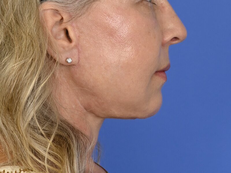 Buccal Fat Removal Before & After Image