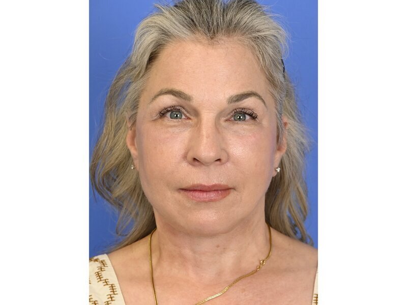 Buccal Fat Removal Before & After Image