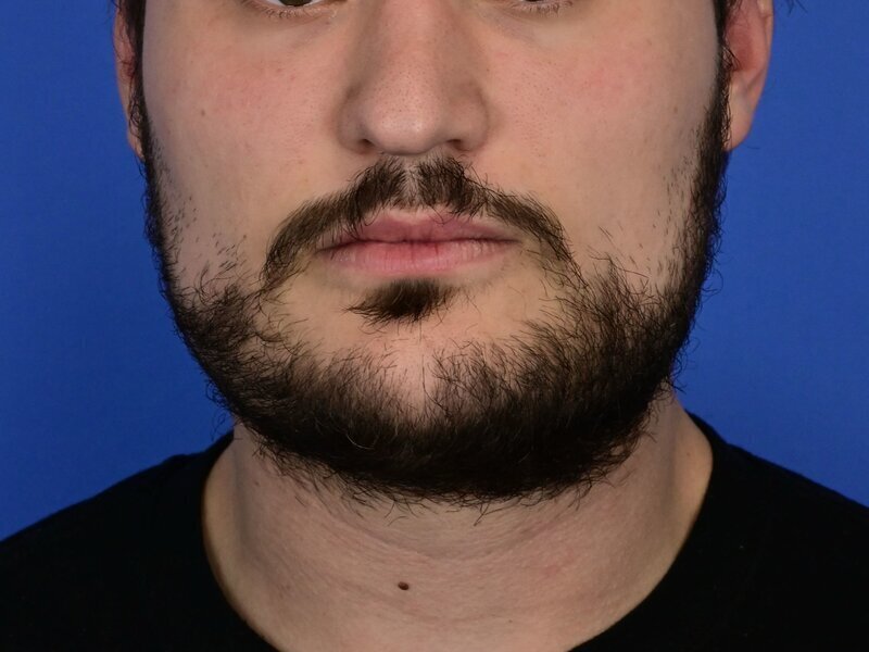 Buccal Fat Removal Before & After Image