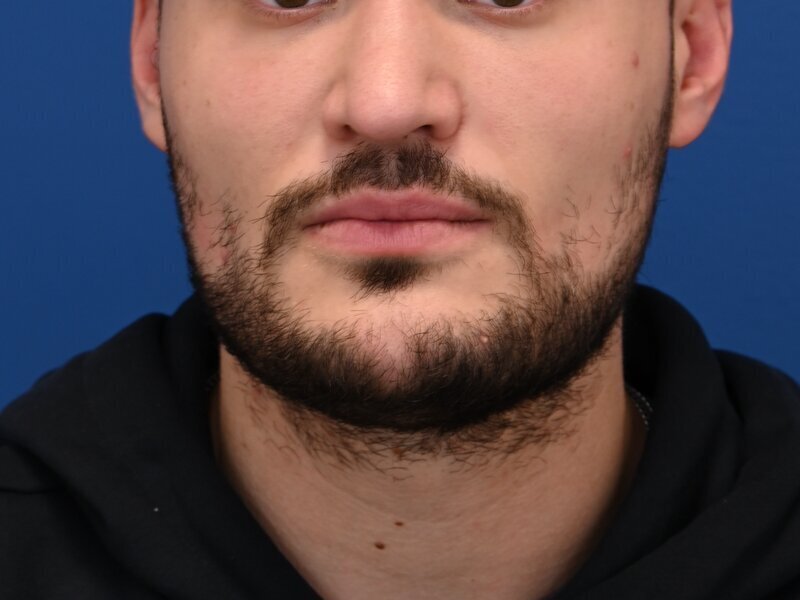 Buccal Fat Removal Before & After Image