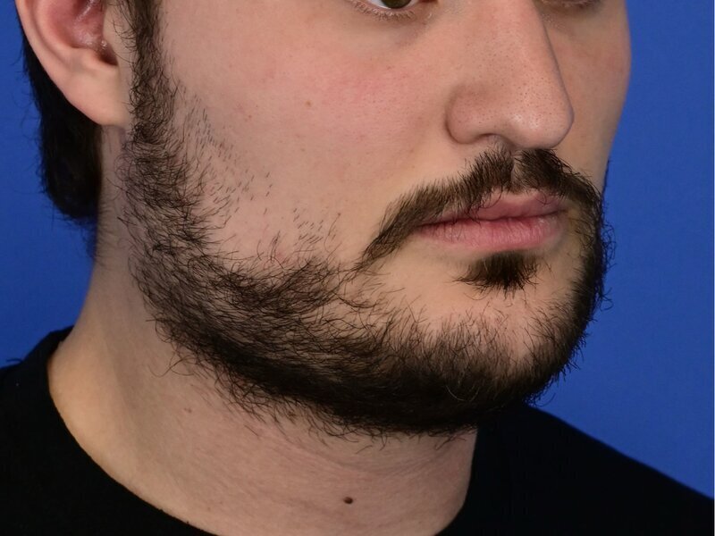 Buccal Fat Removal Before & After Image