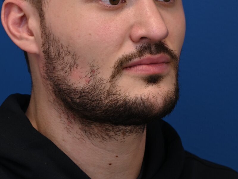 Buccal Fat Removal Before & After Image