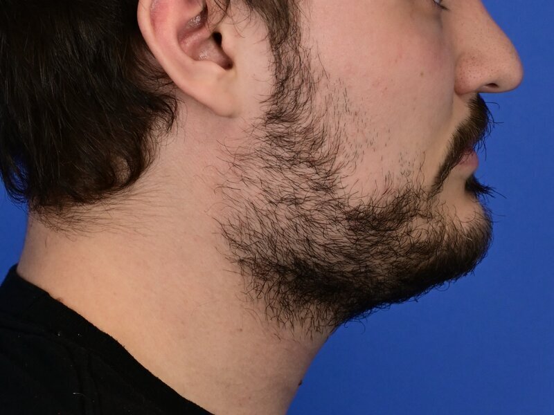 Buccal Fat Removal Before & After Image