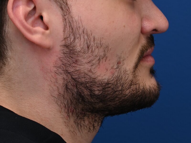 Buccal Fat Removal Before & After Image