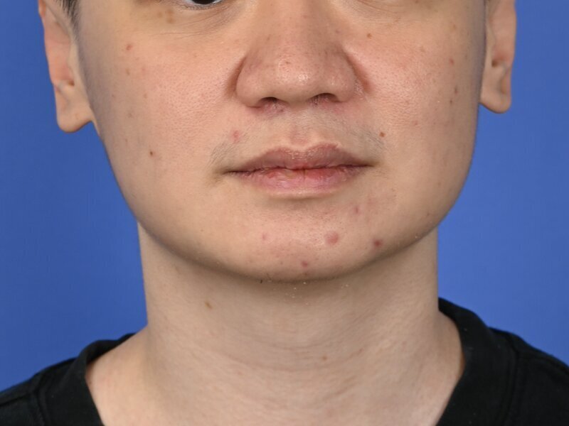 Buccal Fat Removal Before & After Image