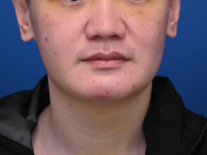 Buccal Fat Removal Before & After Image