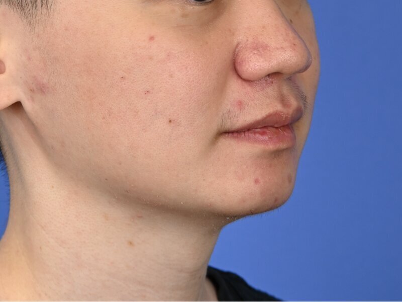 Buccal Fat Removal Before & After Image