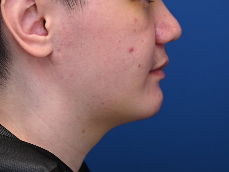 Buccal Fat Removal Before & After Image