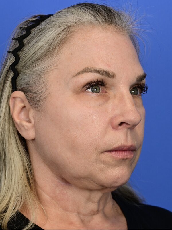 Fat Grafting Before & After Image