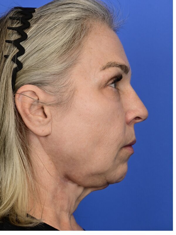 Fat Grafting Before & After Image