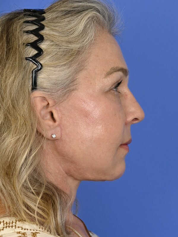 Fat Grafting Before & After Image