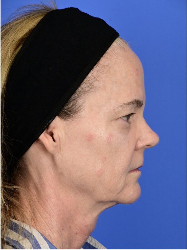 Fat Grafting Before & After Image