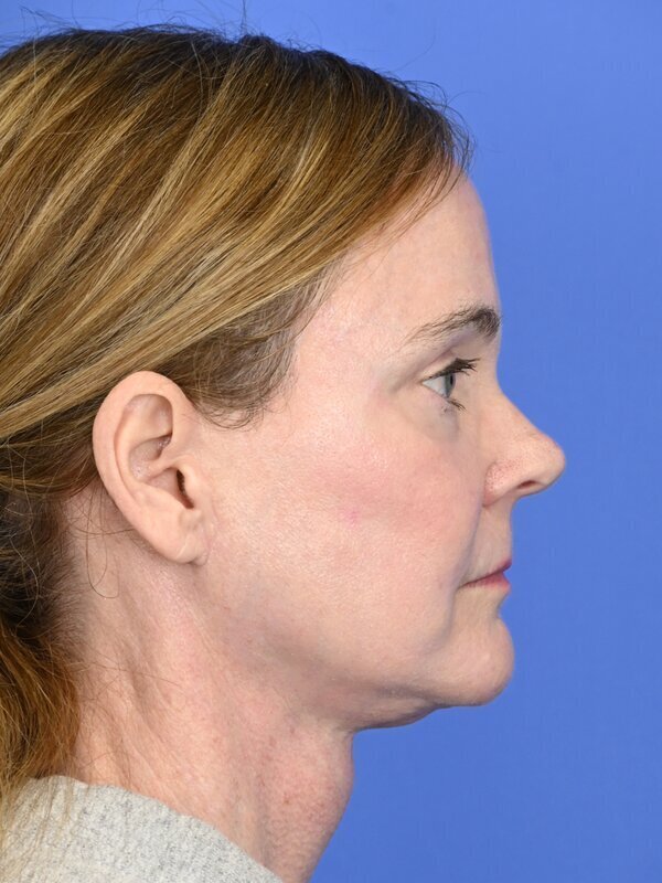 Fat Grafting Before & After Image