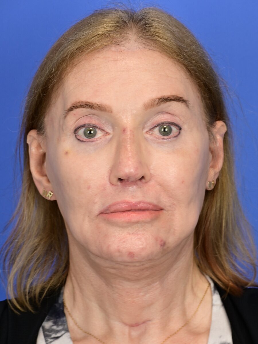 Fat Grafting Before & After Image