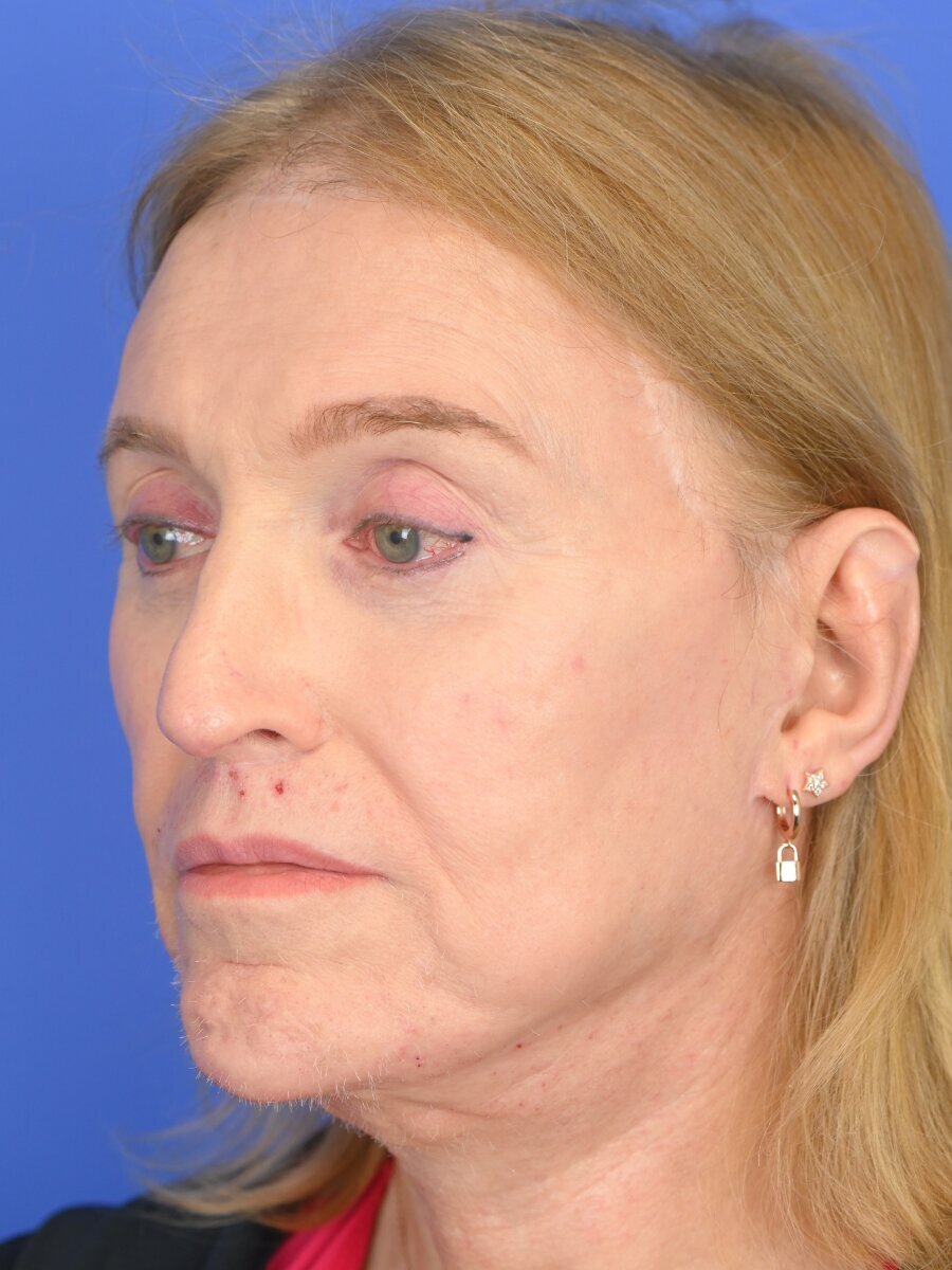 Fat Grafting Before & After Image