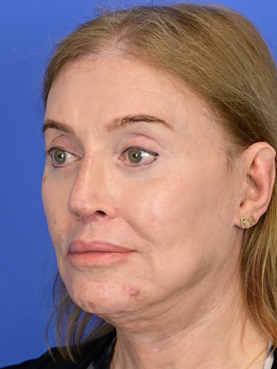 Fat Grafting Before & After Image