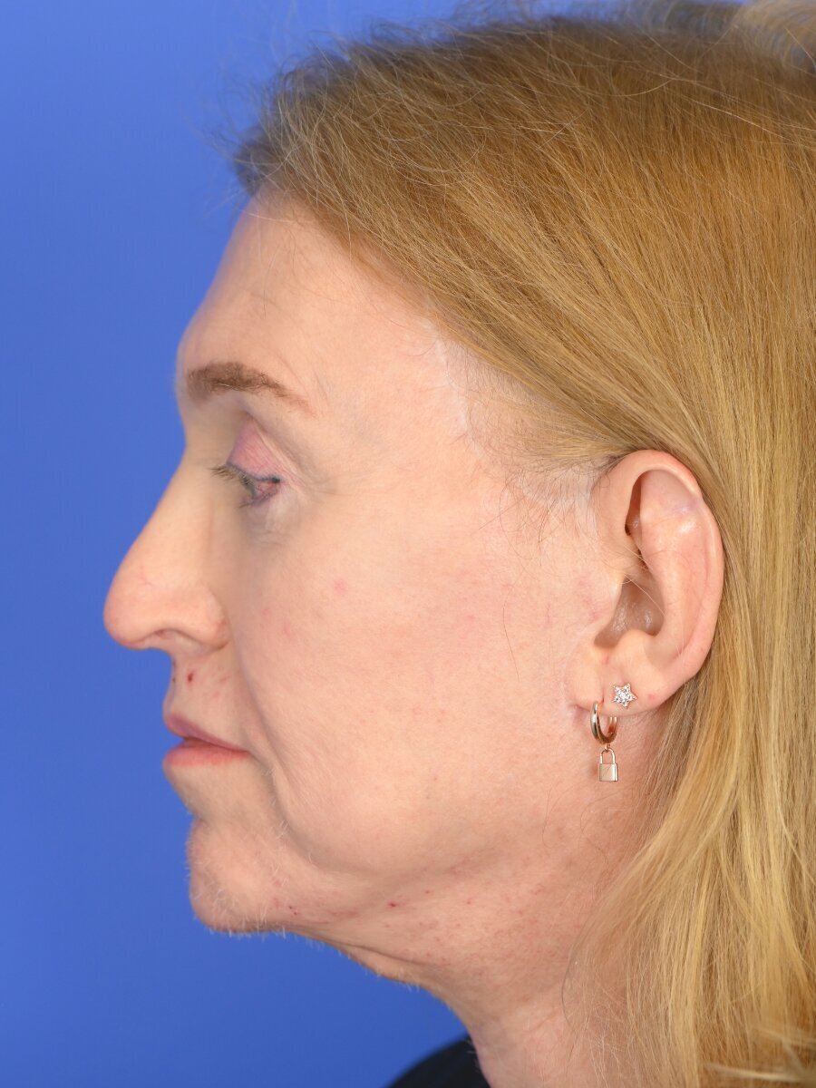 Fat Grafting Before & After Image