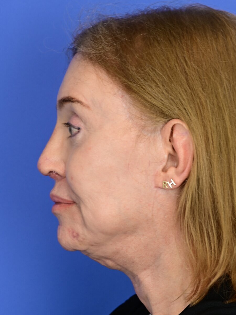 Fat Grafting Before & After Image