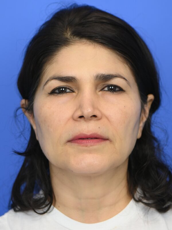 Fat Grafting Before & After Image