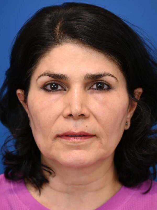 Fat Grafting Before & After Image