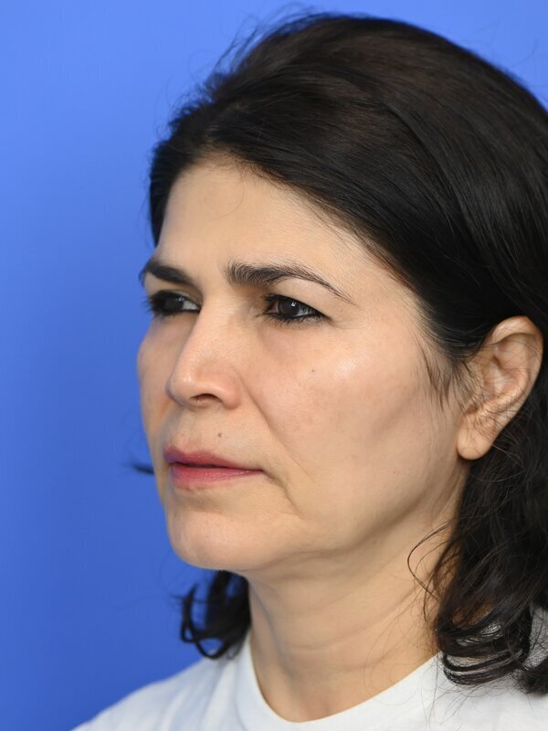 Fat Grafting Before & After Image