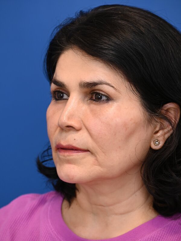 Fat Grafting Before & After Image