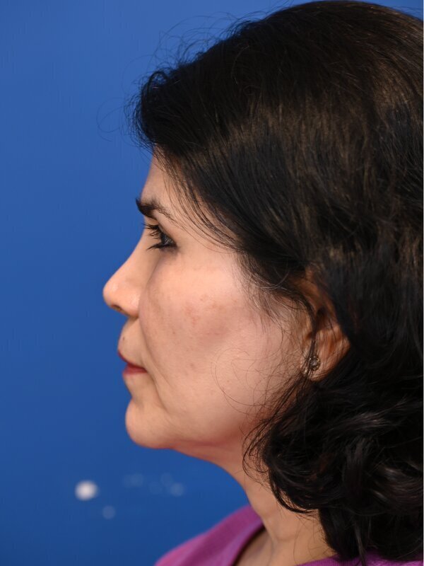 Fat Grafting Before & After Image