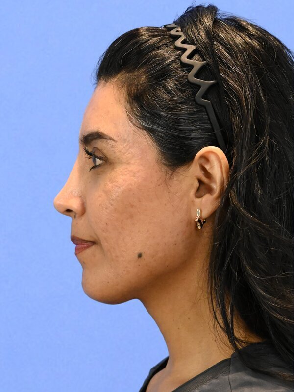 Fat Grafting Before & After Image