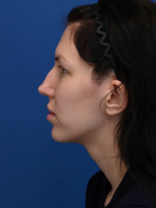 Fat Grafting Before & After Image