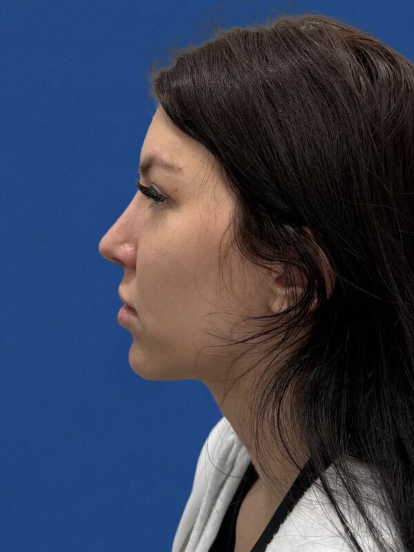 Fat Grafting Before & After Image