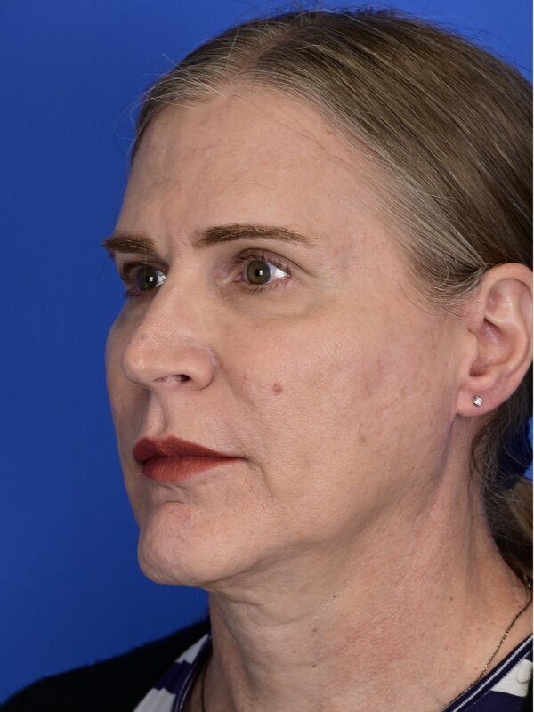 Fat Grafting Before & After Image