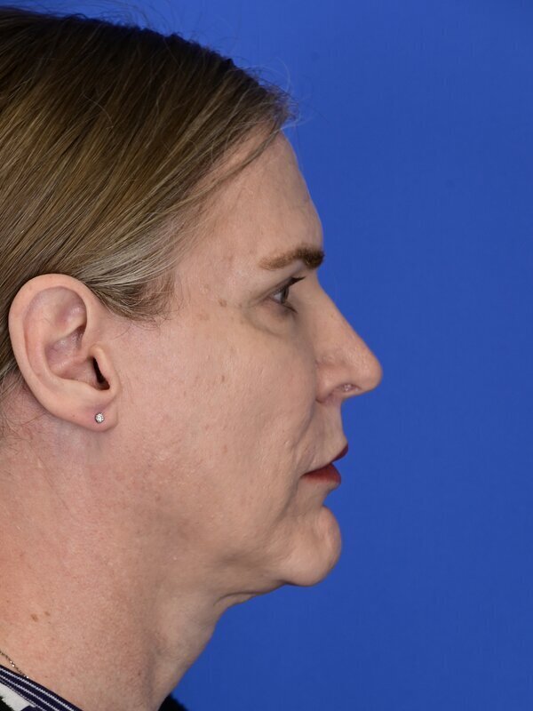 Fat Grafting Before & After Image