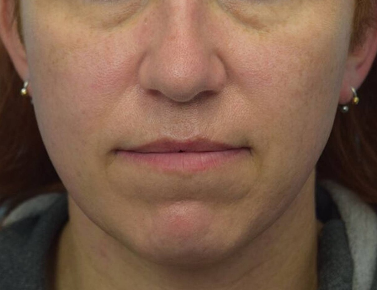 Augmentation Genioplasty Before & After Image