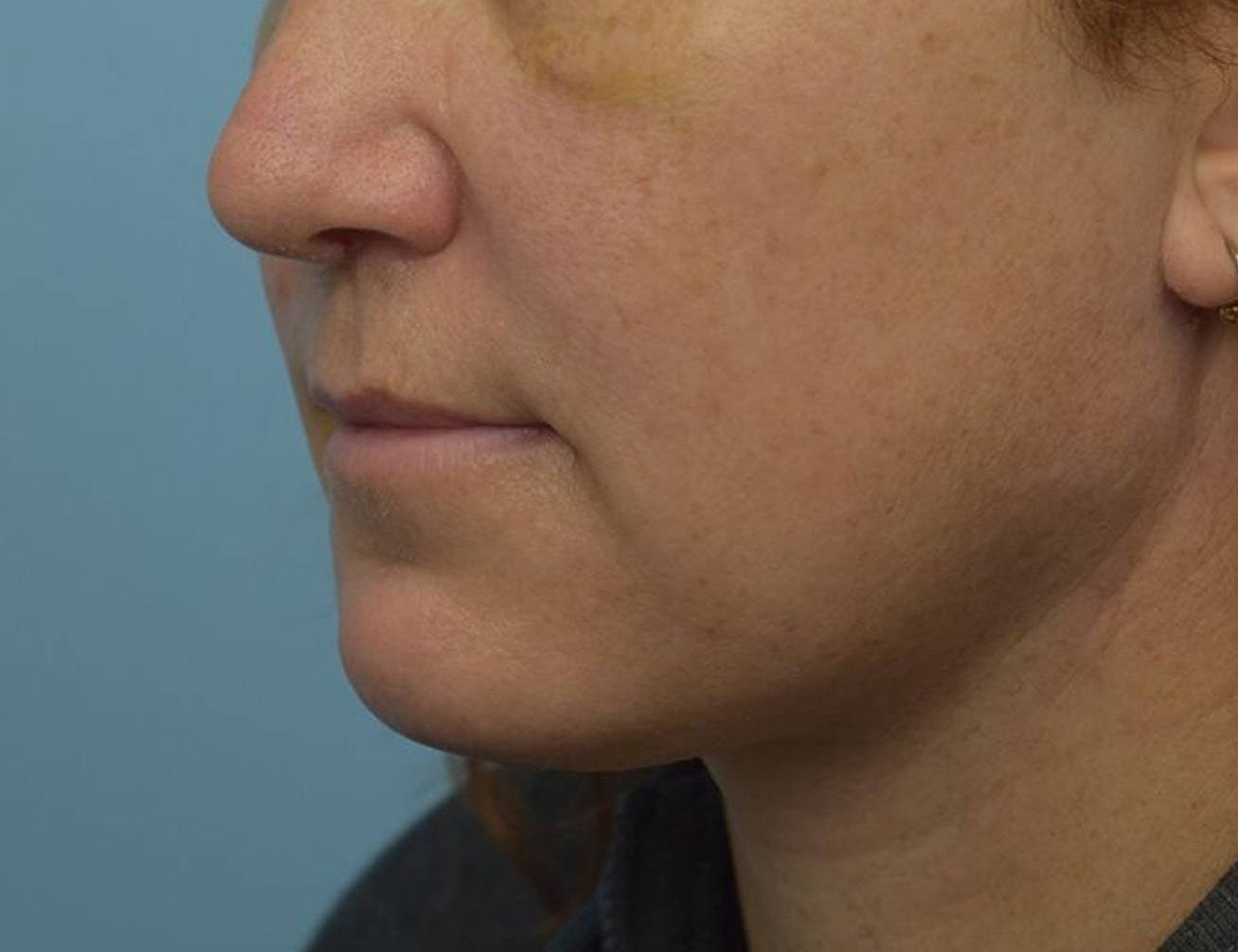 Augmentation Genioplasty Before & After Image